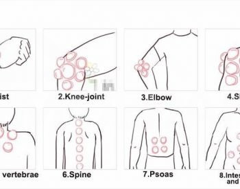 მასაჟის ვაკუუმის ქილები 12 ც თბილისი - photo 3