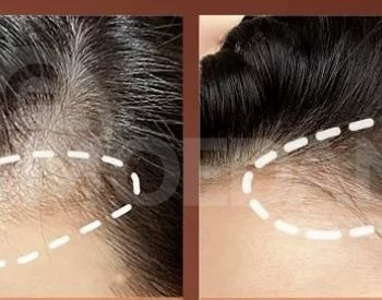 პოლიგენური საპონი თბილისი - photo 3